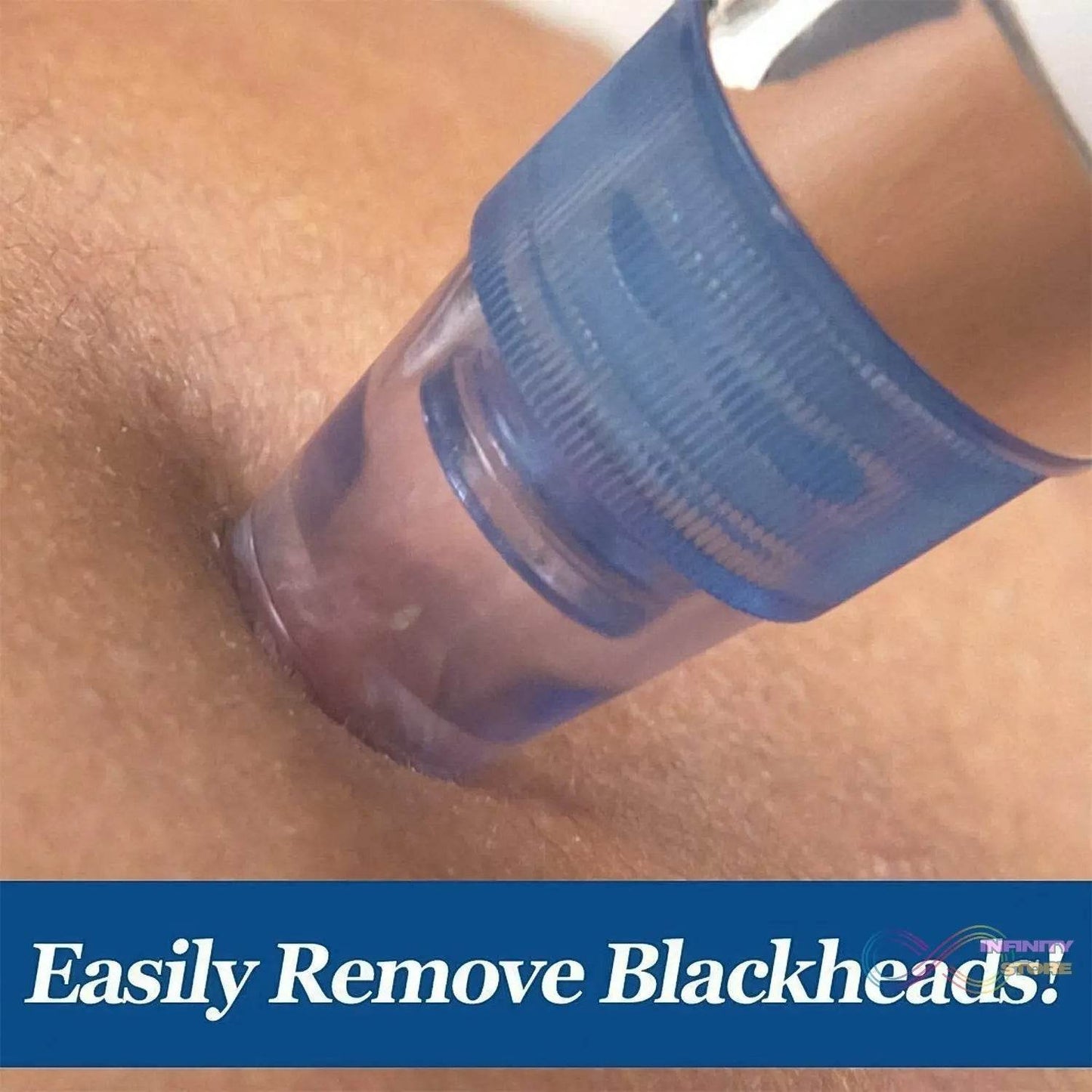 2 in 1 Blackhead Whitehead Extractor Remover Device (Multi - Color / 1 Set / batteries not included) - infinityexculsivestore.com
