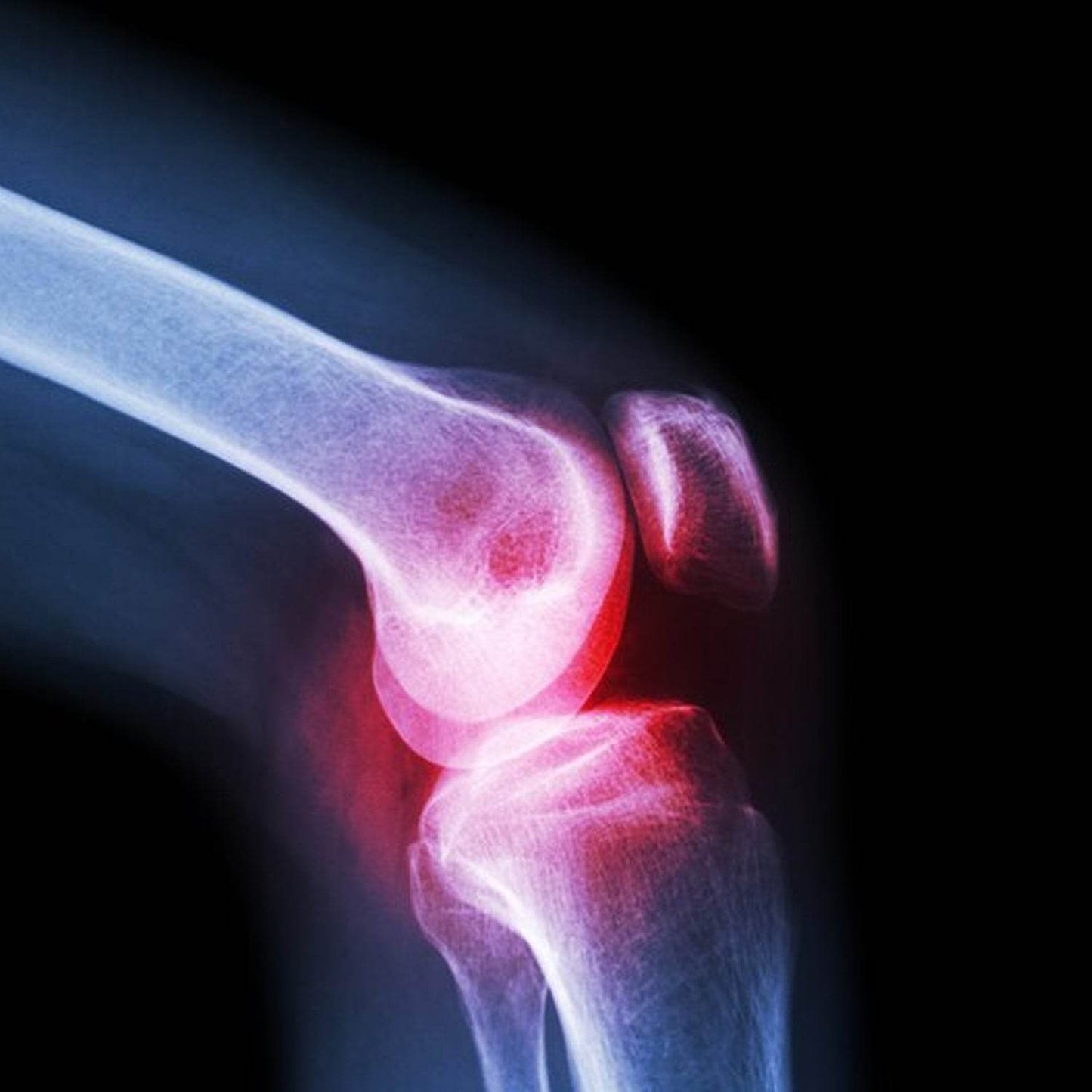 Knee Cap for Knee Support (Large) - infinityexculsivestore.com