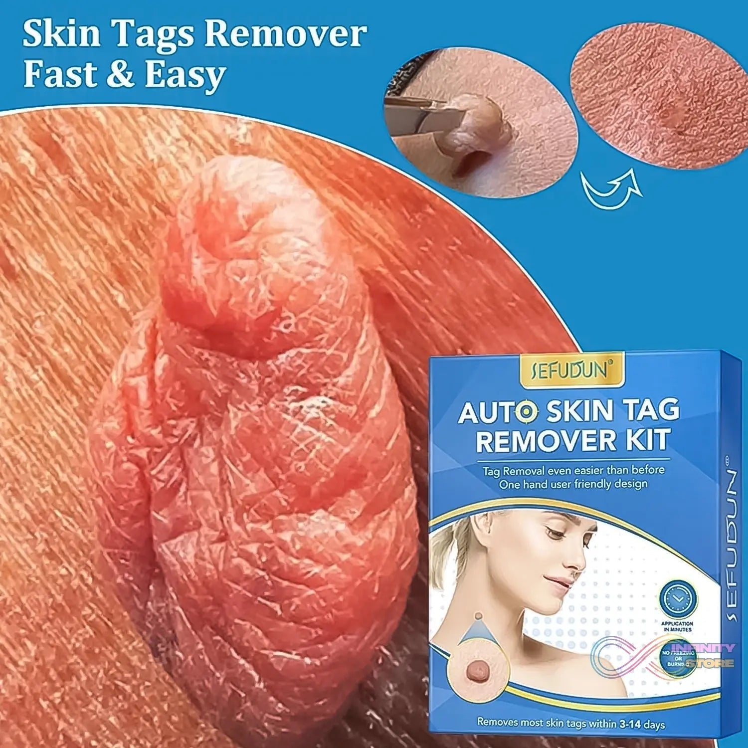 Skin Tag Remover Kit 2 in 1 for Micro to Large (2 mm - 8 mm / 1 Set) - infinityexculsivestore.com