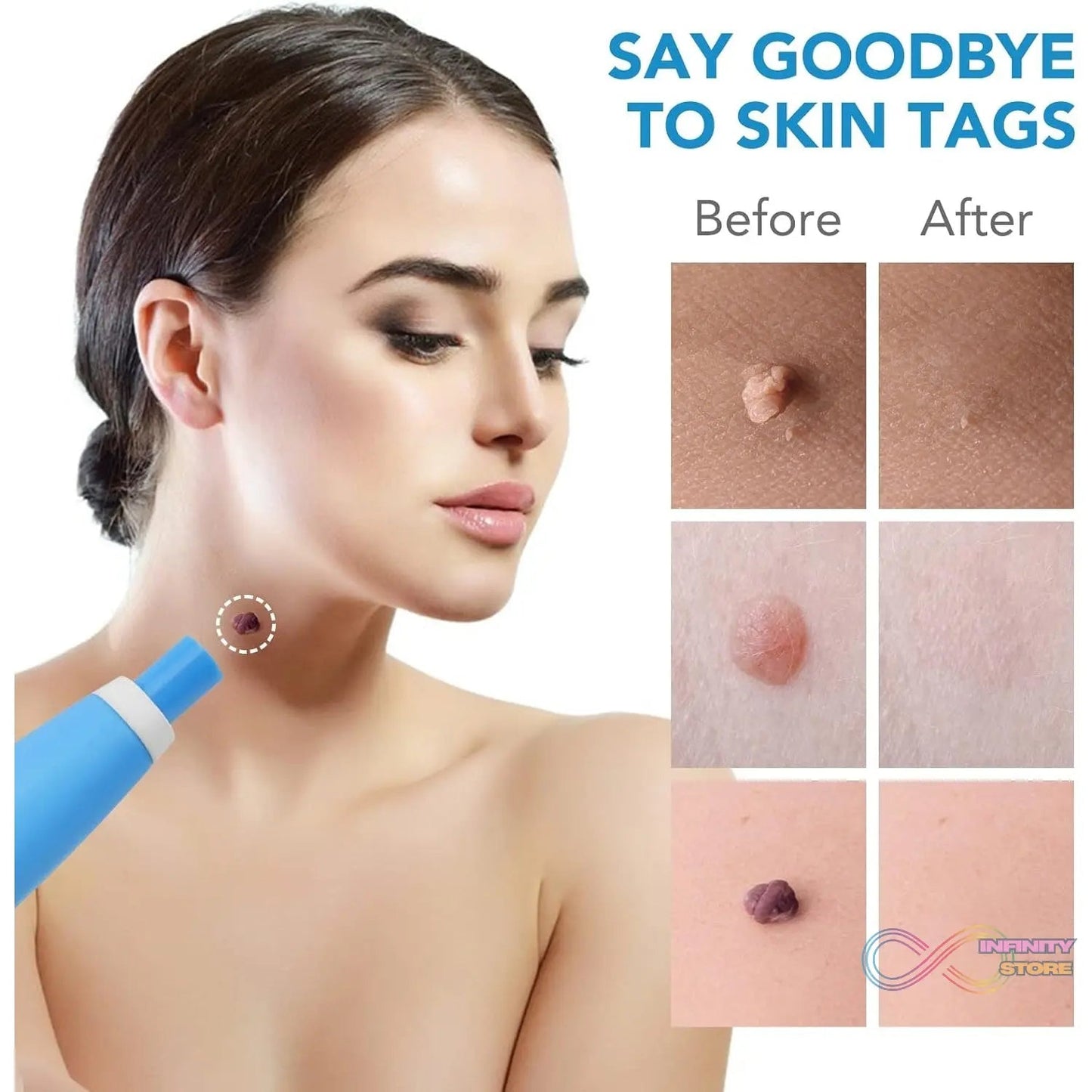 Skin Tag Remover Kit 2 in 1 for Micro to Large (2 mm - 8 mm / 1 Set) - infinityexculsivestore.com