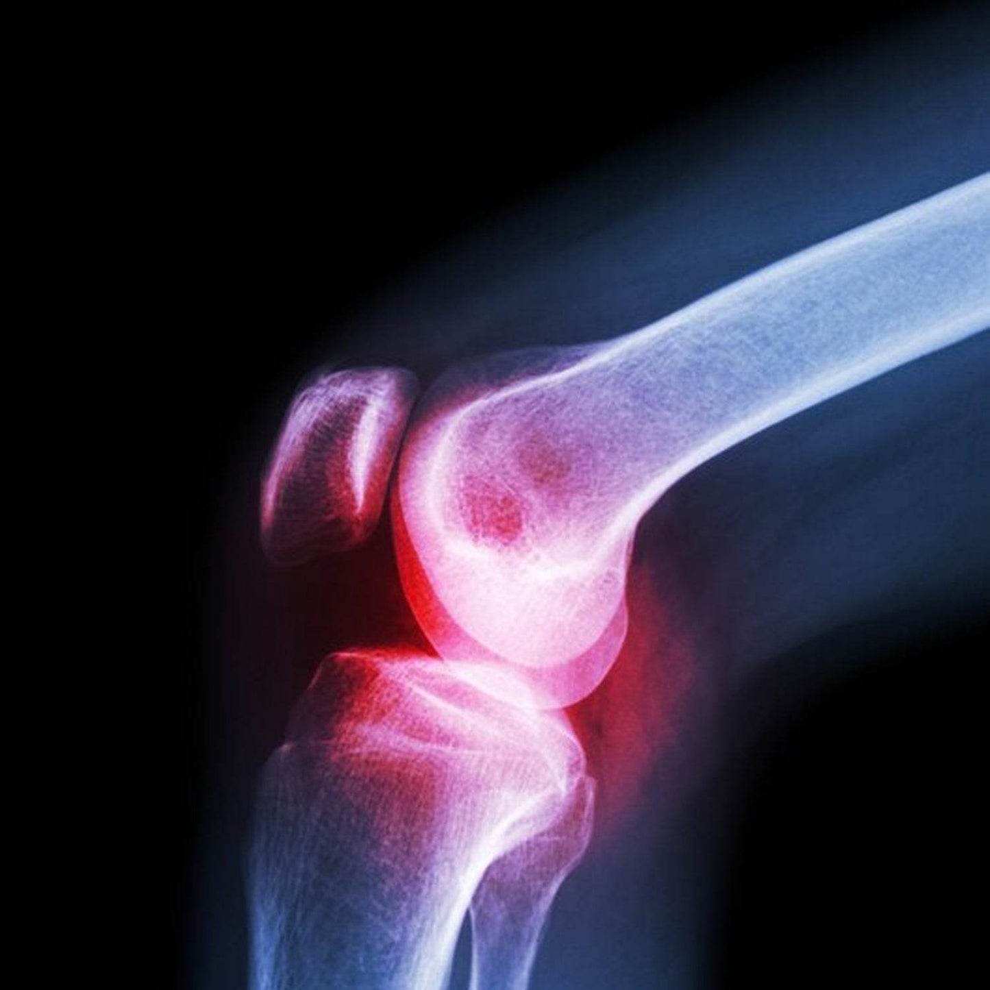 (XL) Knee Cap for Knee Support - infinityexculsivestore.com