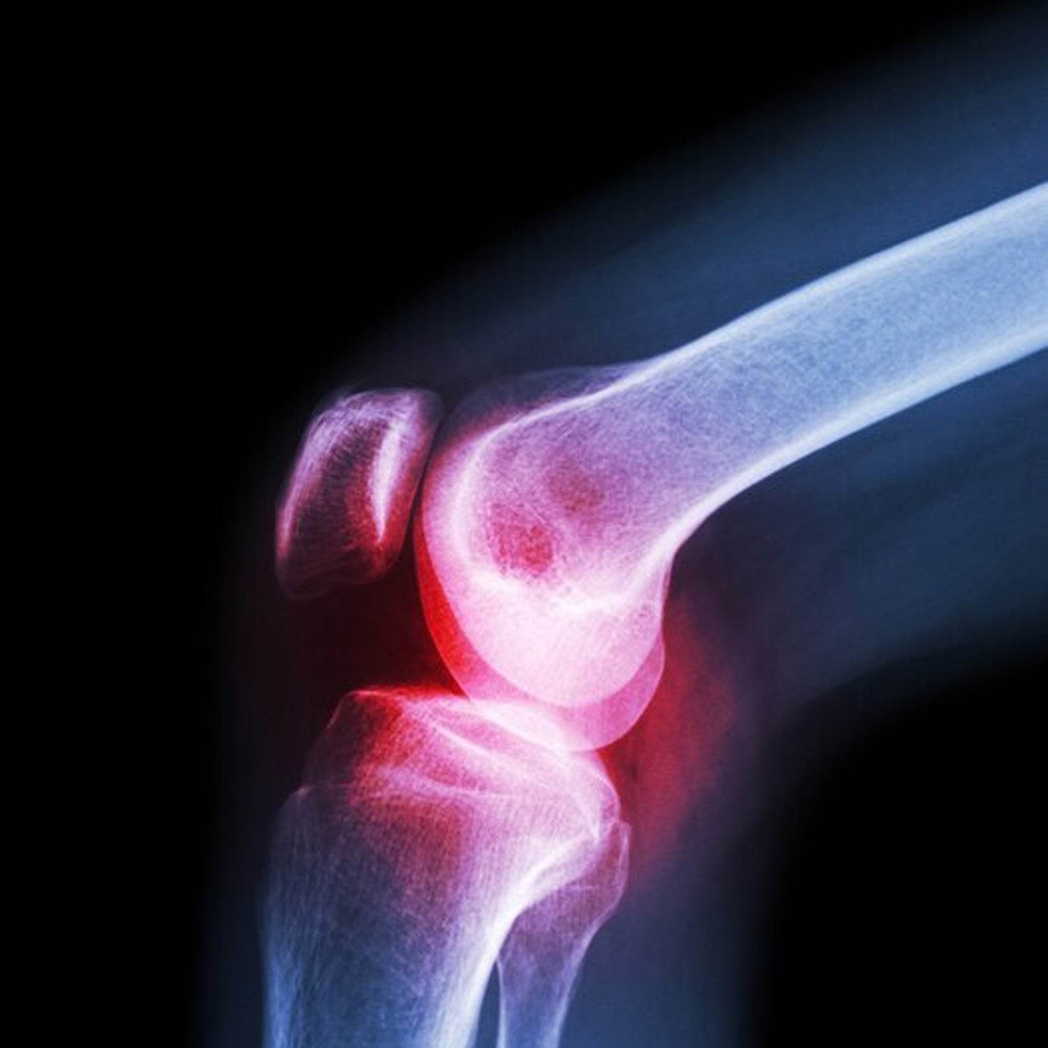(XL) Knee Cap for Knee Support - infinityexculsivestore.com