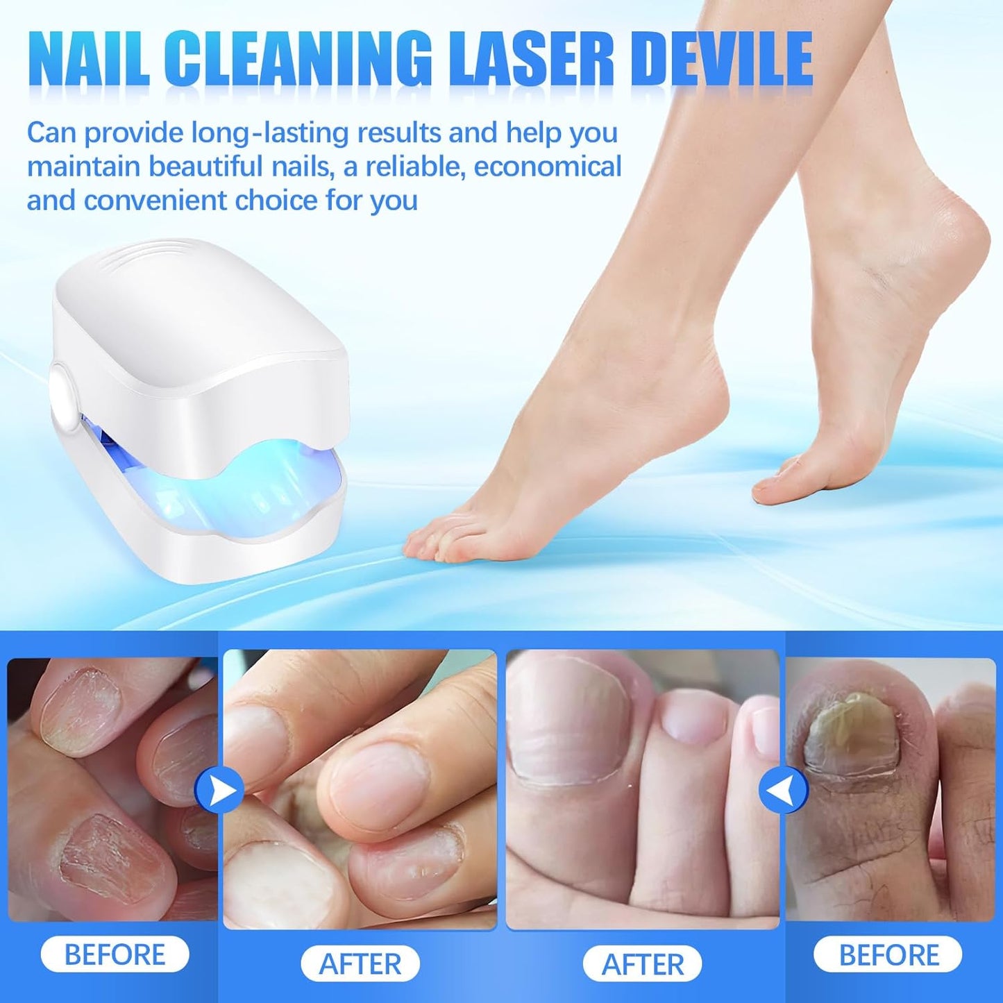 Rechargeable Nail Fungus Treatment for Toenail, Toe Nail Fungal Treatment Nail Fungus Laser Device, Anti - Fungal Nail Treatment for Hand & Feet Infections Remover for Home Use - infinityexculsivestore.com