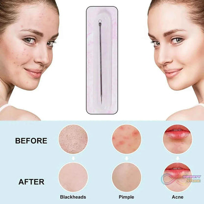 Blackhead Remover Needle (1 Pc / With Case) - infinityexculsivestore.com